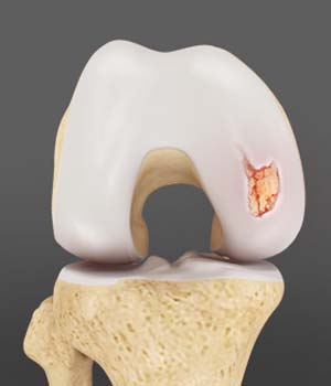 Articular Cartilage Defects