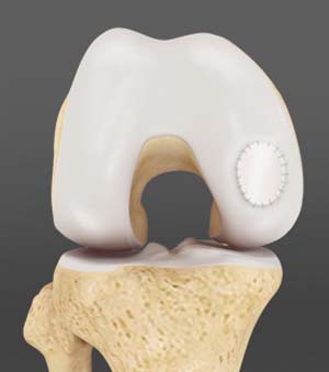 Cartilage Transplantation