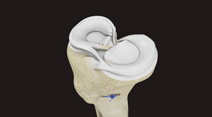 Meniscal Repair
